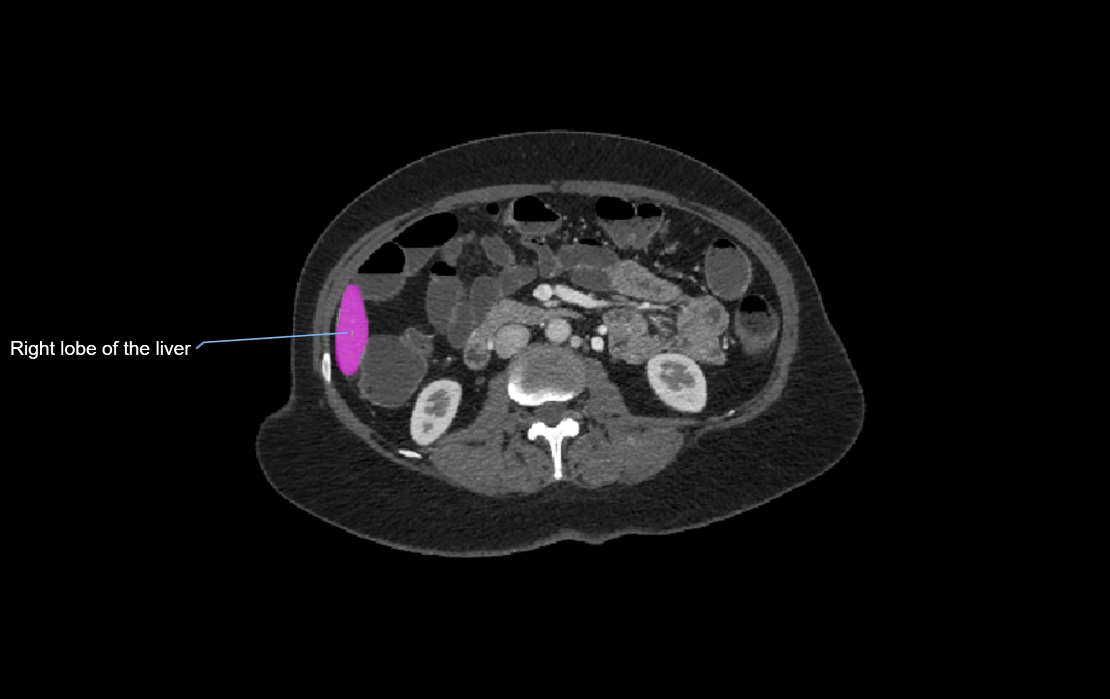 CT lliver lobes axial cross sectional anatomy labelled image -00007.webp